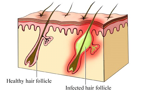 folliculitus