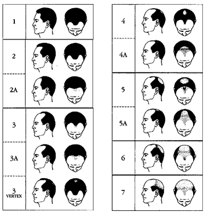 Norwood Hair Loss Chart